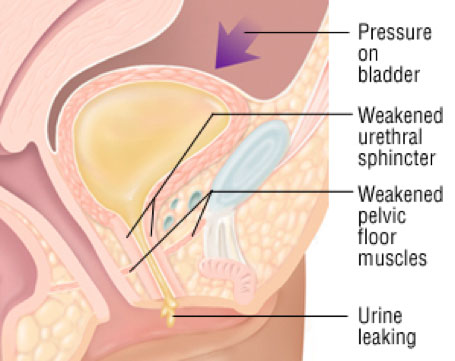 Urinary Incontinence