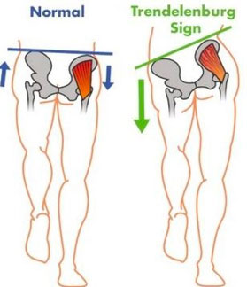 Normal vs Trendelenburg sign