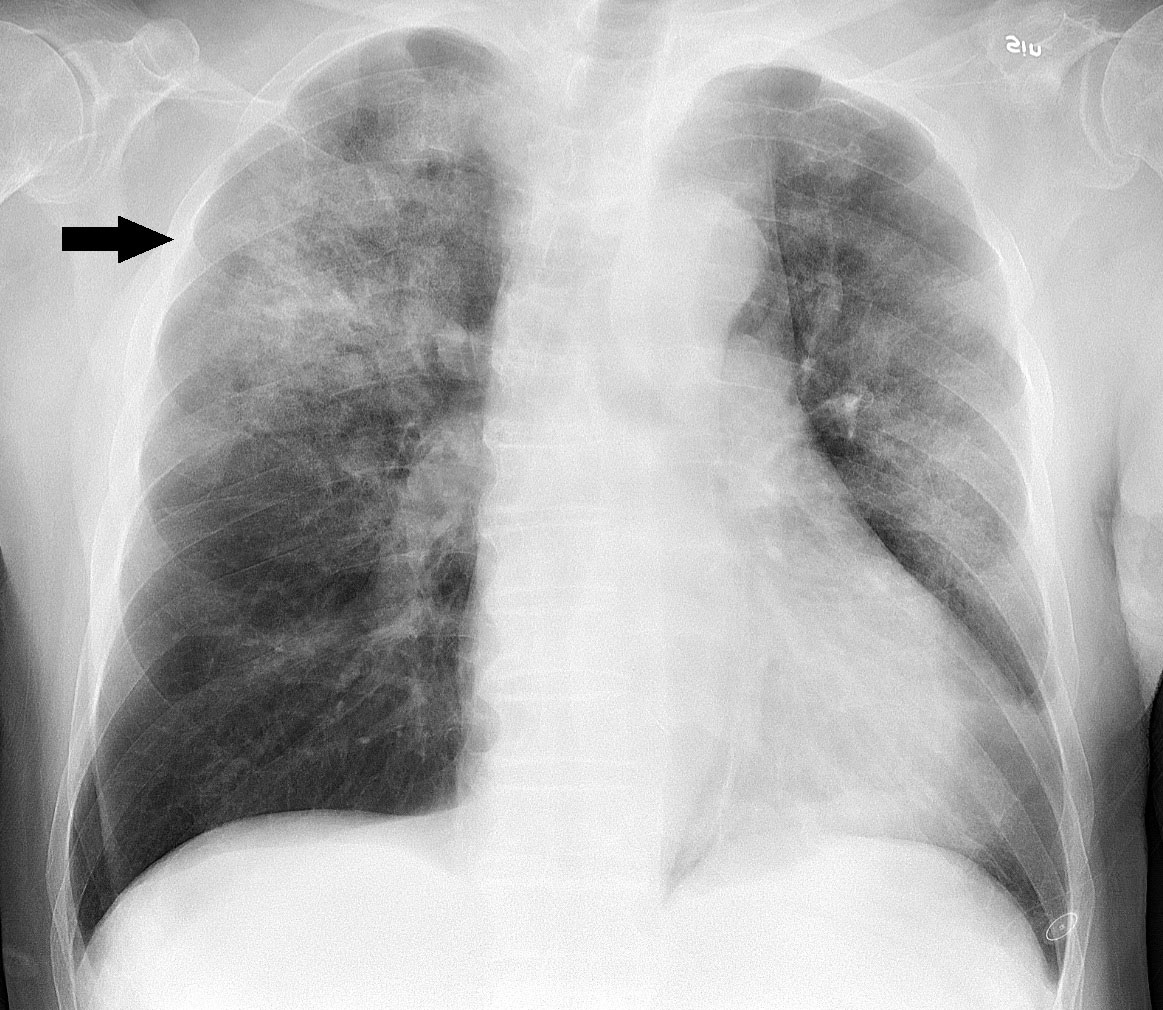 Chest X-ray