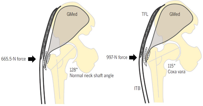 Normal neck shaft angle vs Coxa Vara