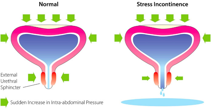 Normal vs Stress Incontinence