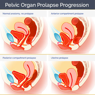 Pelvic Organ Prolapse Progression
