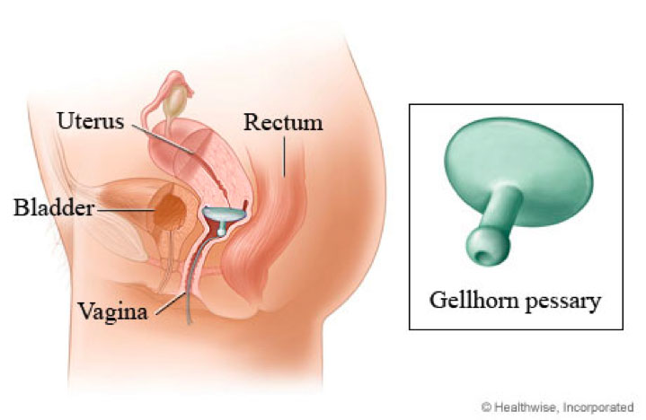 Gellhorn pessary can be used for the treatment of pelvic organ prolapse