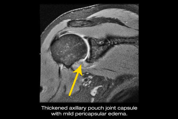 Thickened axillary pouch joint capsule