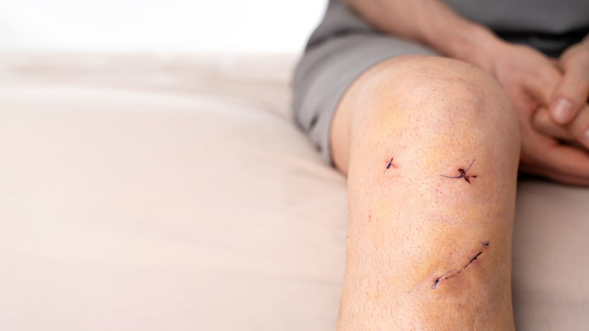 What to Expect After ACL Surgery: Your First Two Weeks