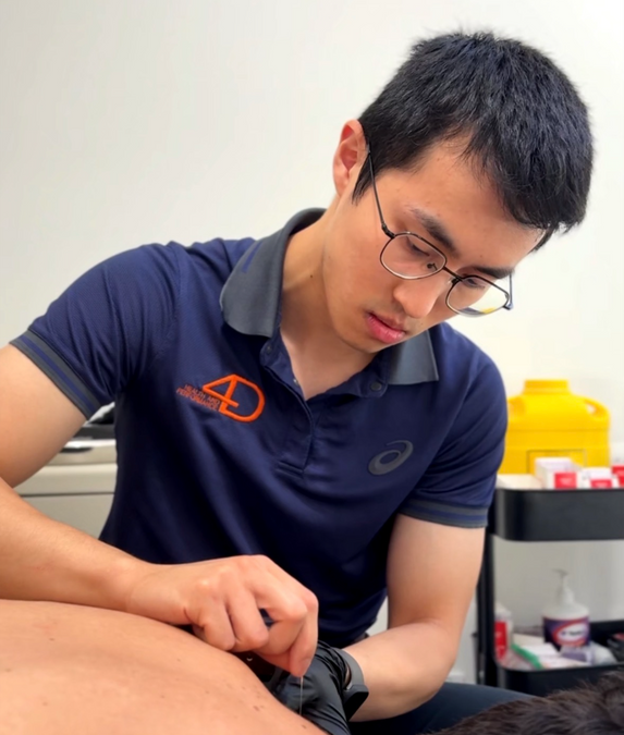 Dry Needling: What It Is, How It Works, and Whether It's Right for You
