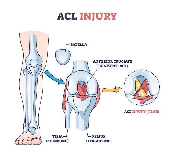 What Is an ACL Injury? A Plain-Language Guide