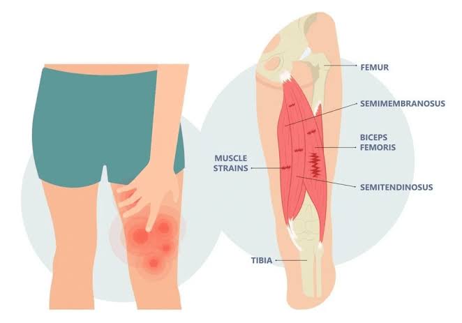 Hamstring Pain: Tendinopathy vs Strain Guide