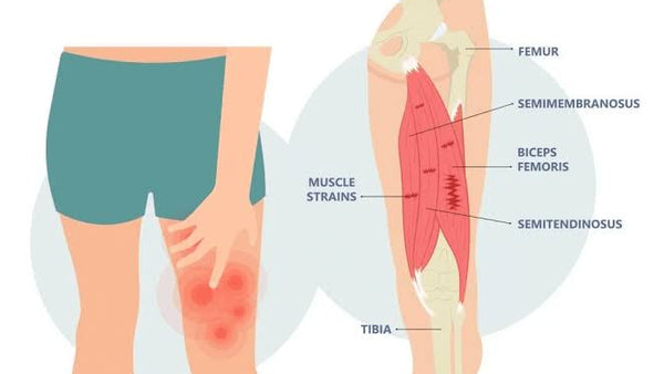 Hamstring Pain: Tendinopathy vs Strain Guide