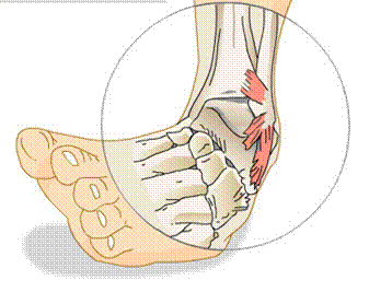 Lateral Ankle Sprains: Recovery Guide