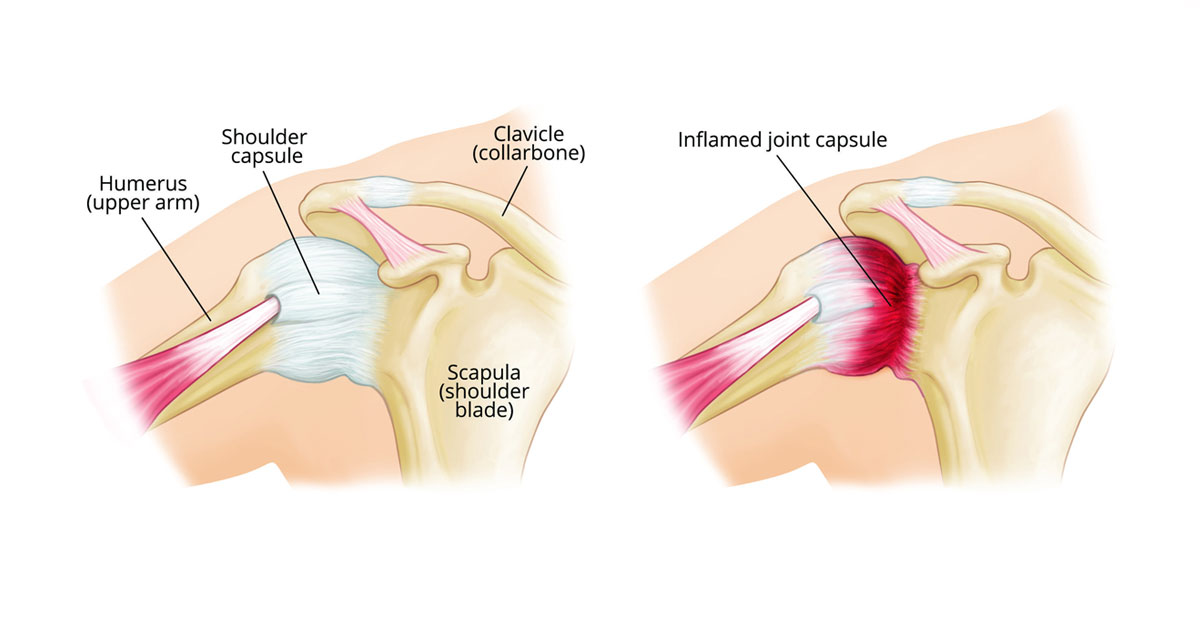 10 facts you may not already know about frozen shoulder.