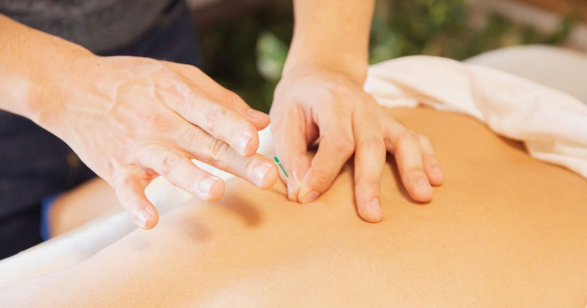 Exploring the Benefits of Dry Needling: An Effective Therapy for Pain Relief